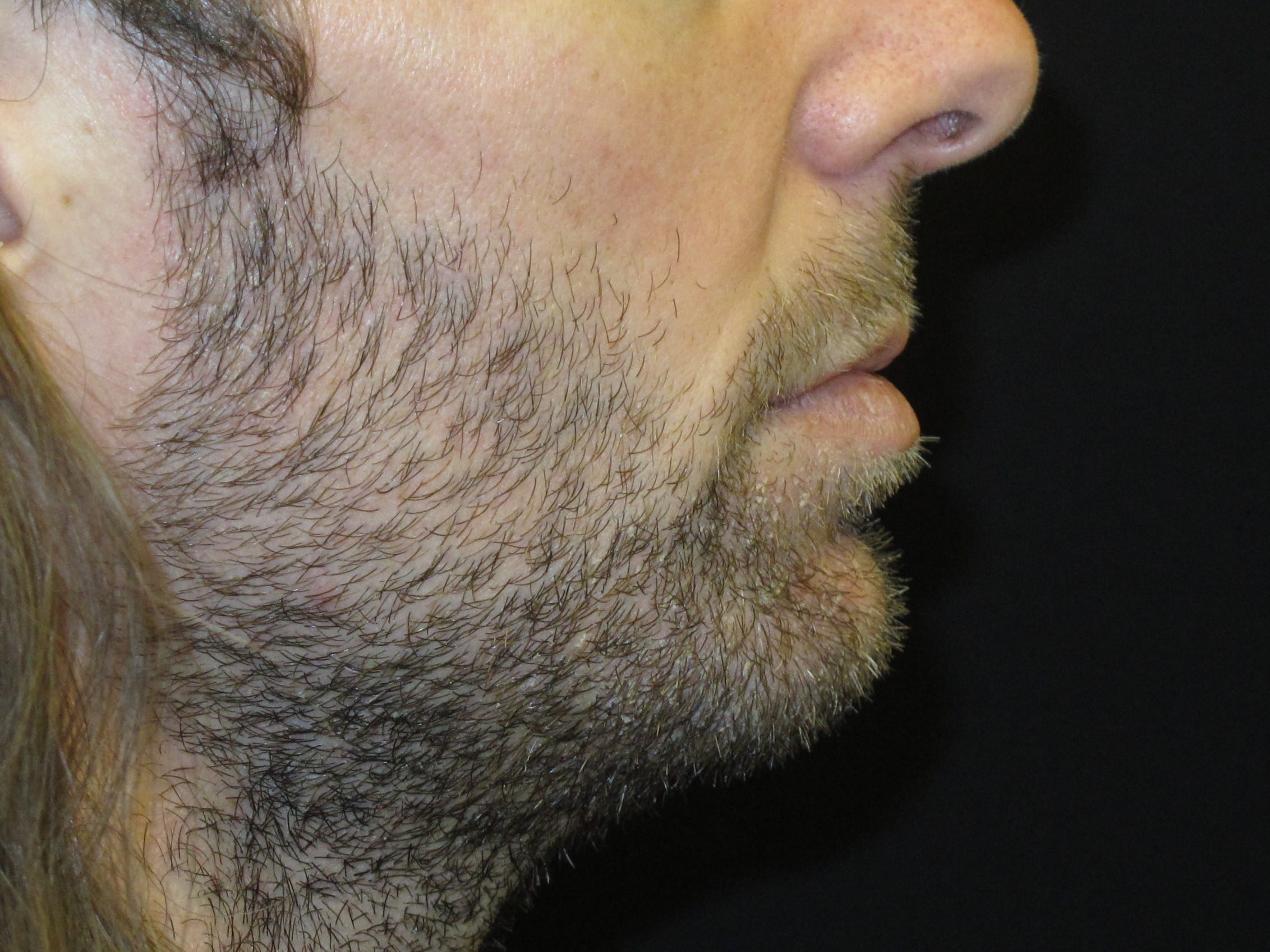 Chin Implant Patient Photo - Case Case 6 - after view-1