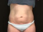 Coolsculpting - Case Case 13 - After