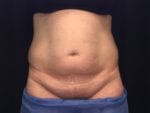 Coolsculpting - Case Case 13 - Before