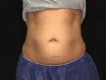 Coolsculpting - Case Case 17 - After