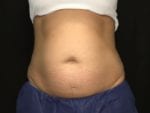 Coolsculpting - Case Case 17 - Before