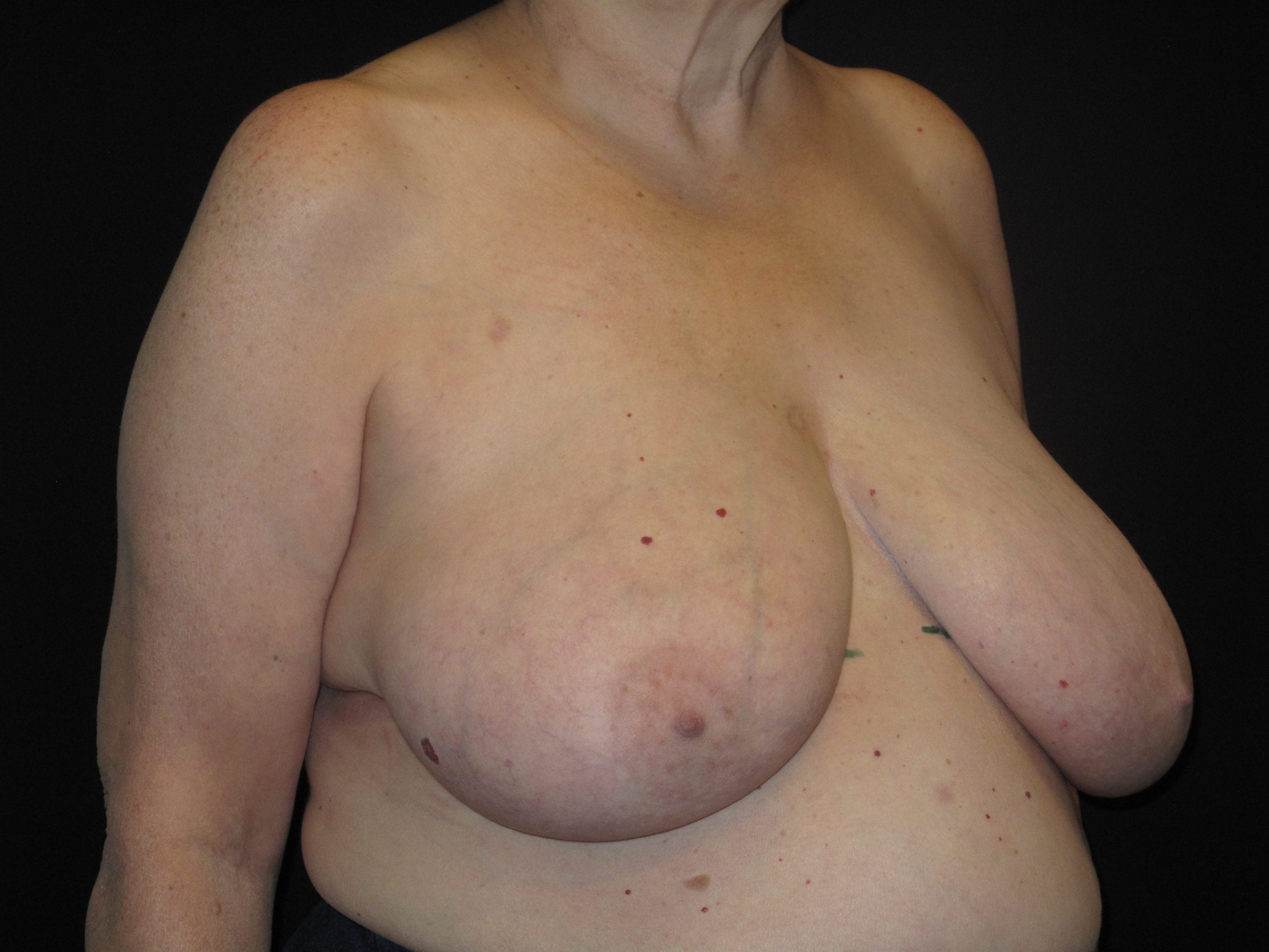 Breast Reduction Patient Photo - Case Case 19 - before view-1