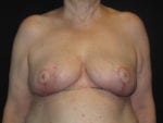 Breast Reduction - Case Case 19 - After