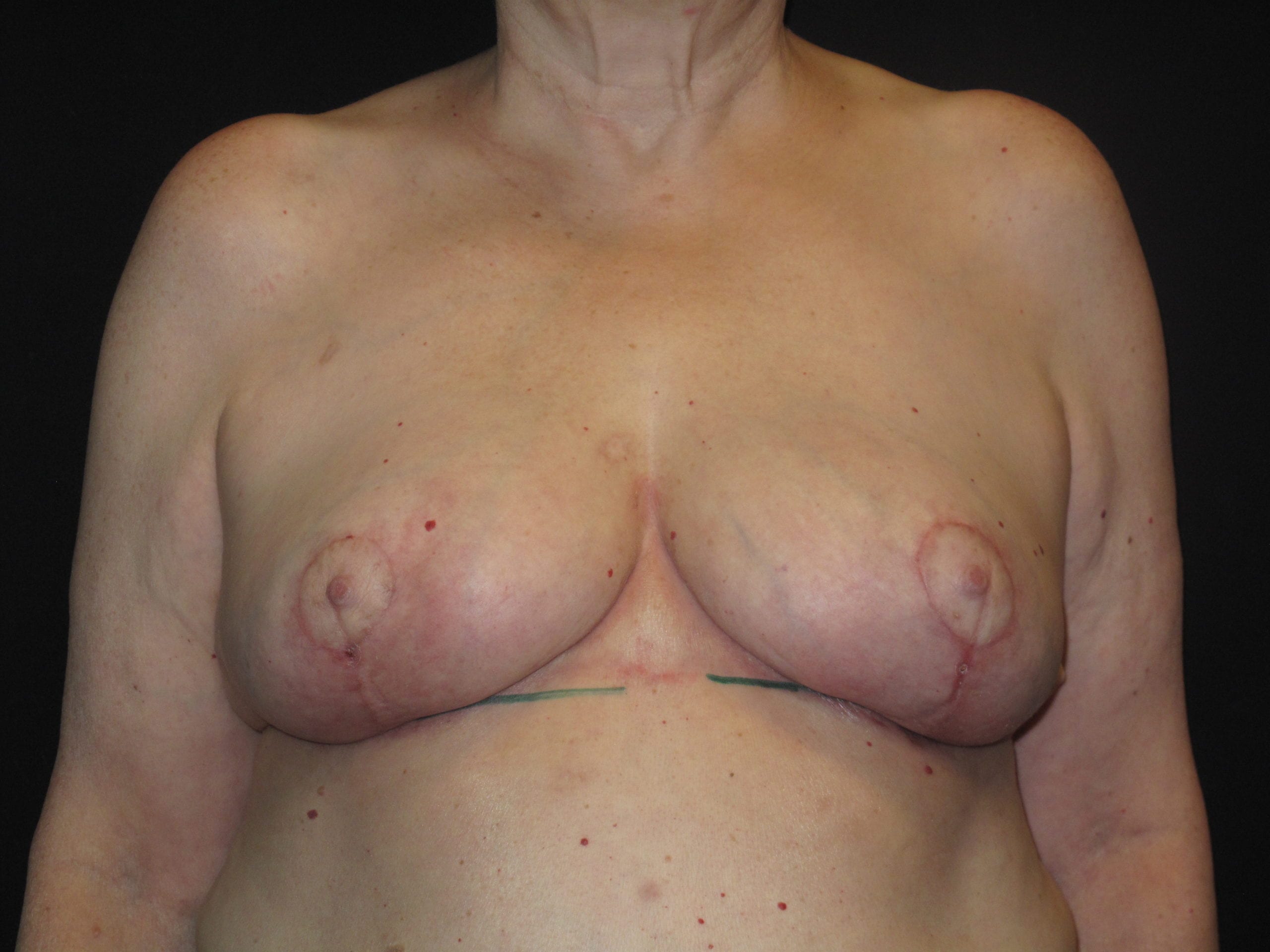 Breast Reduction Patient Photo - Case Case 19 - after view
