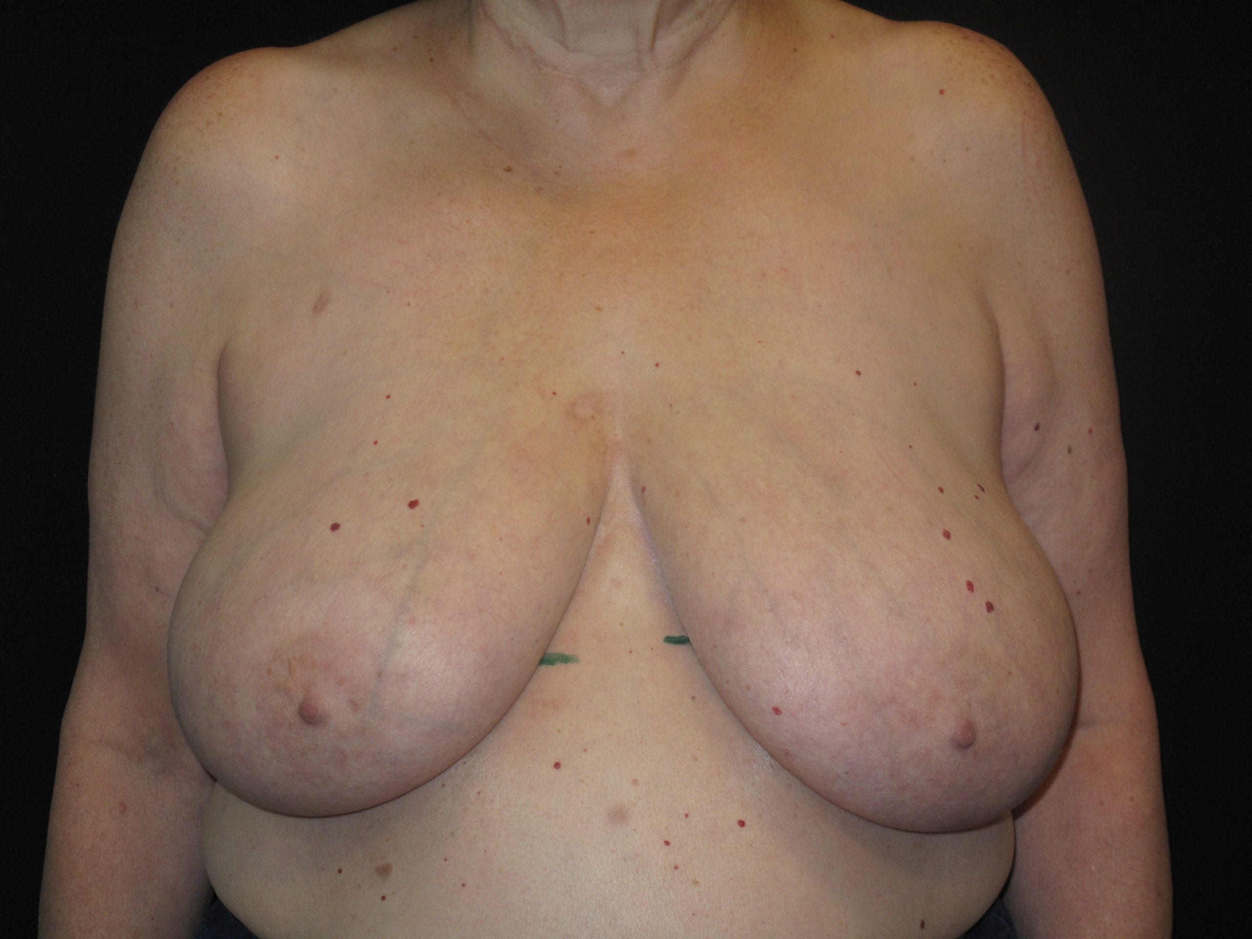 Breast Reduction Patient Photo - Case Case 19 - before view-0