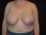 Breast Reduction - Case Case 20 - Before