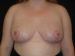 Breast Reduction - Case Case 20 - After