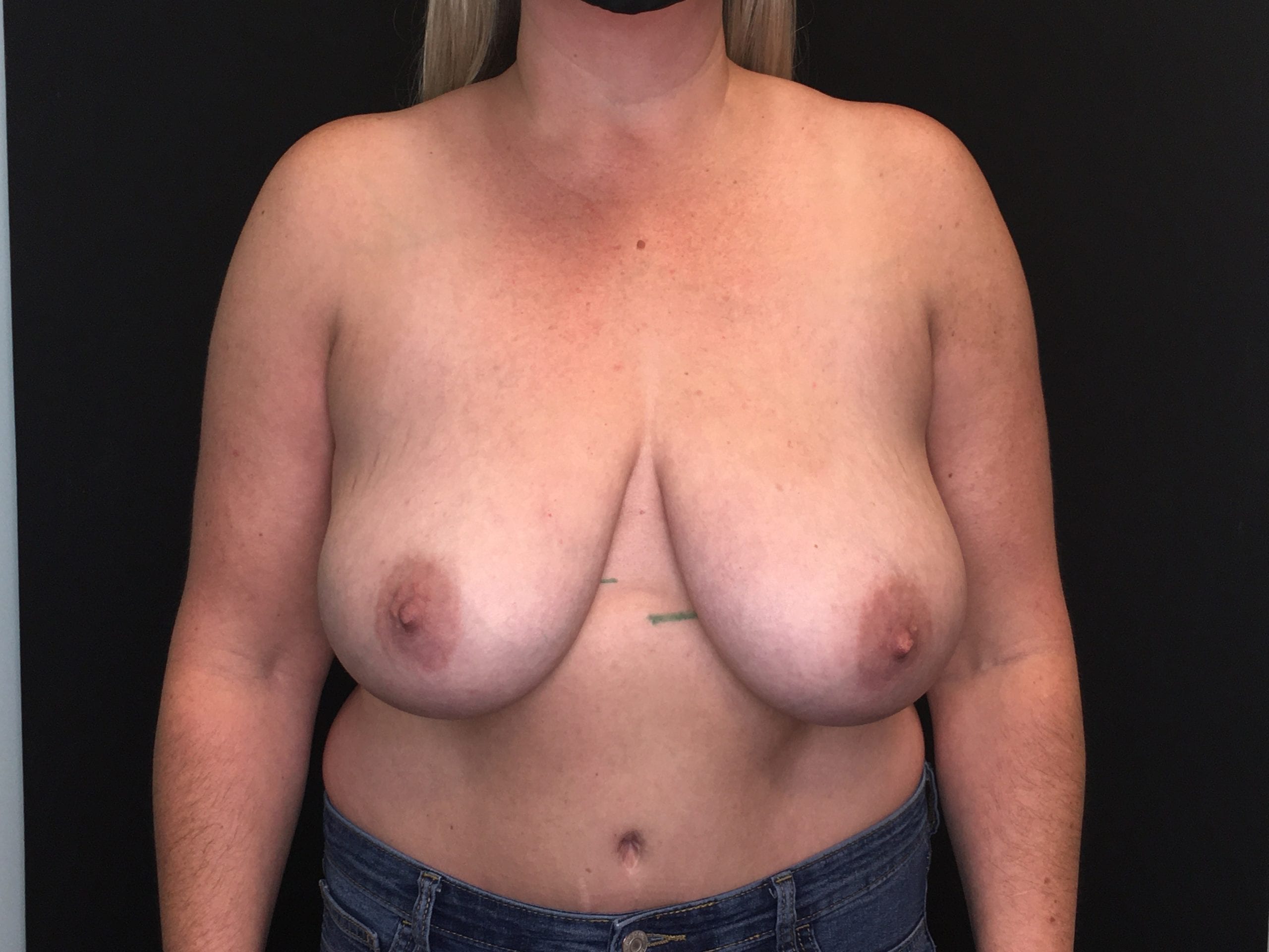 Breast Reduction Patient Photo - Case Case 23 - before view-0