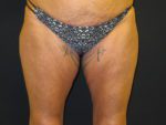 Coolsculpting - Case Case 19 - Before