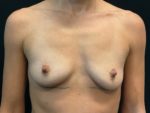 Breast Augmentation - Case Case 61 - Before