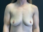 Breast Augmentation - Case Case 63 - Before