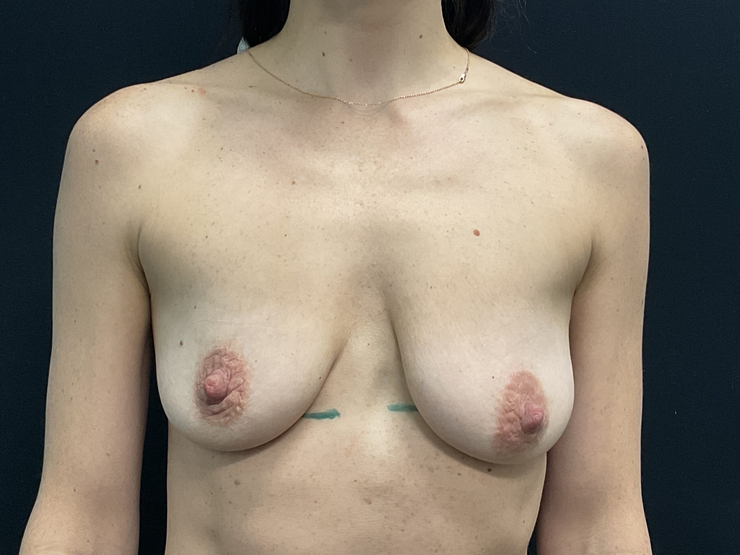 Breast Lift w/ Augmentation Patient Photo - Case Case 22 - before view-