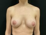 Breast Lift w/ Augmentation - Case Case 22 - After
