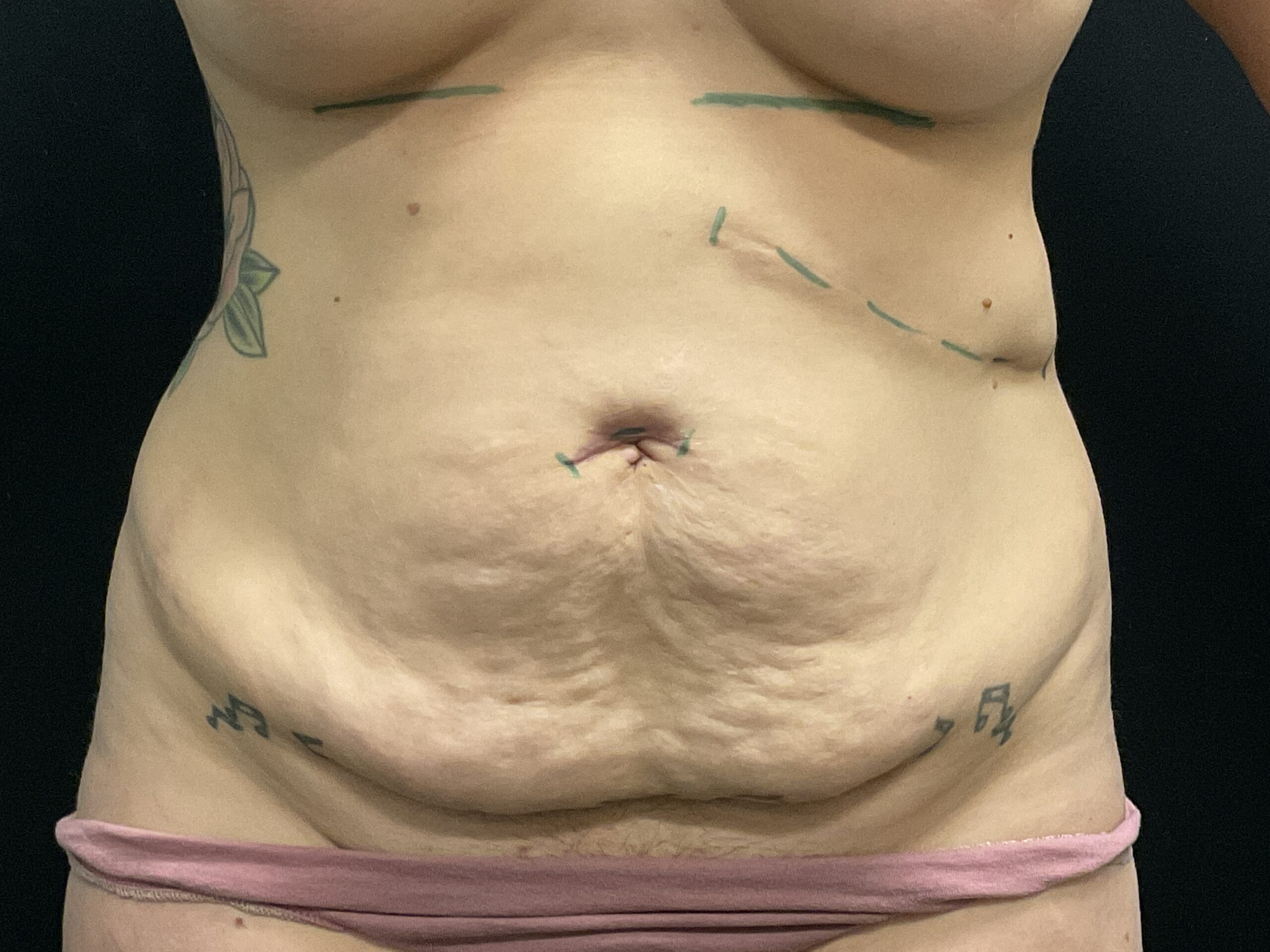 Mini Tummy Tuck Patient Photo - Case Case 7 - before view-