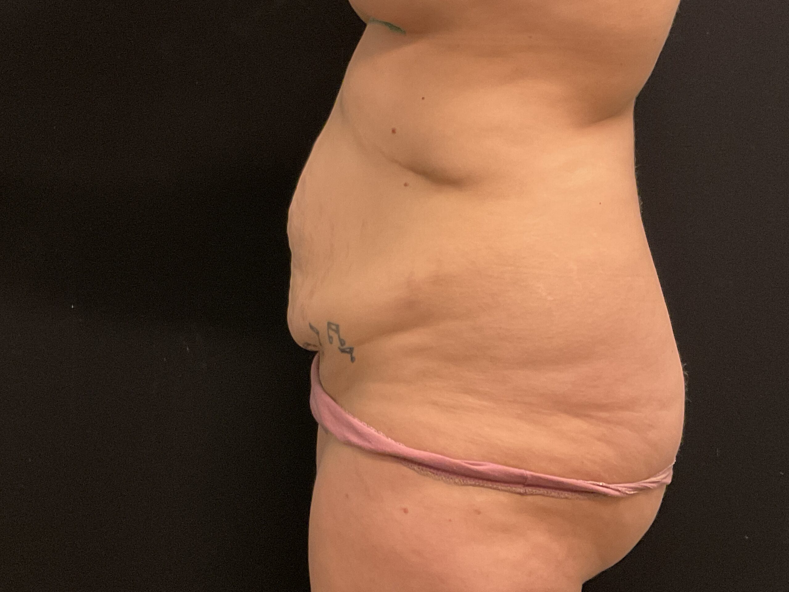 Mini Tummy Tuck Patient Photo - Case Case 7 - before view-1