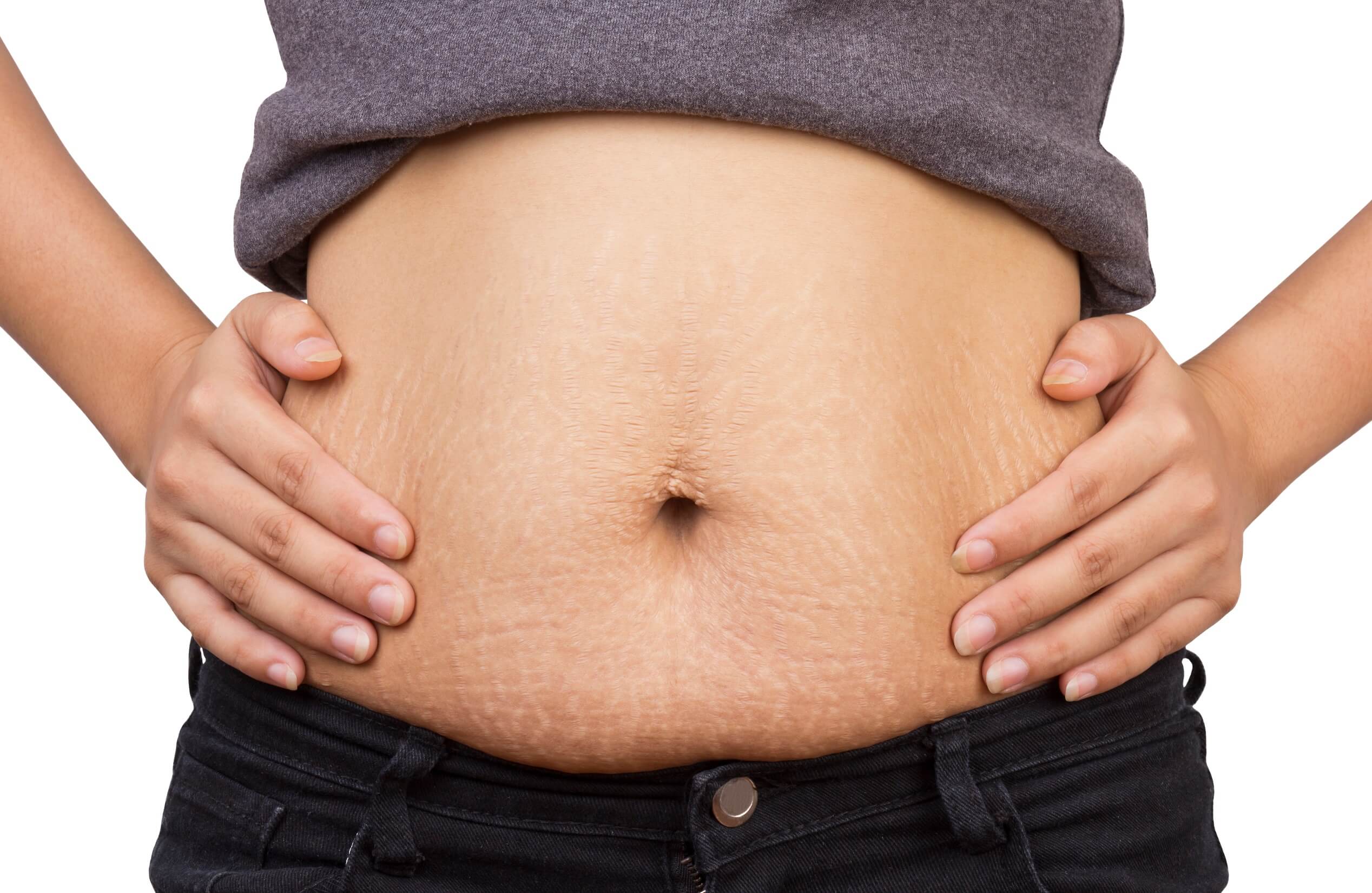 Woman's tummy with stretchmarks posing with her hands over hips