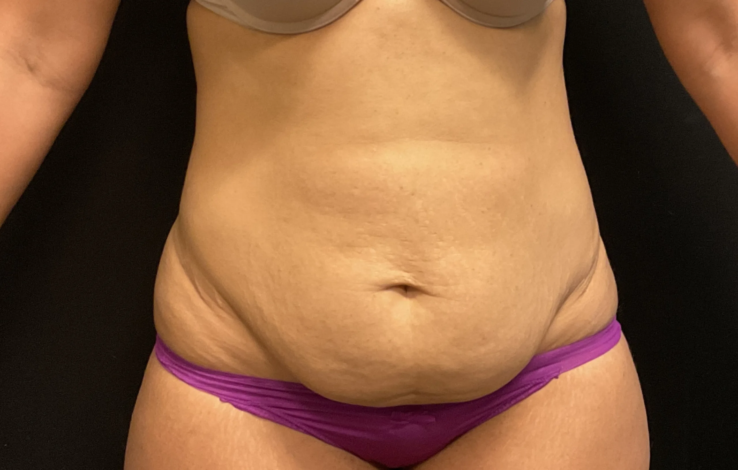 Tummy Tuck Patient Photo - Case Case 23 - before view-