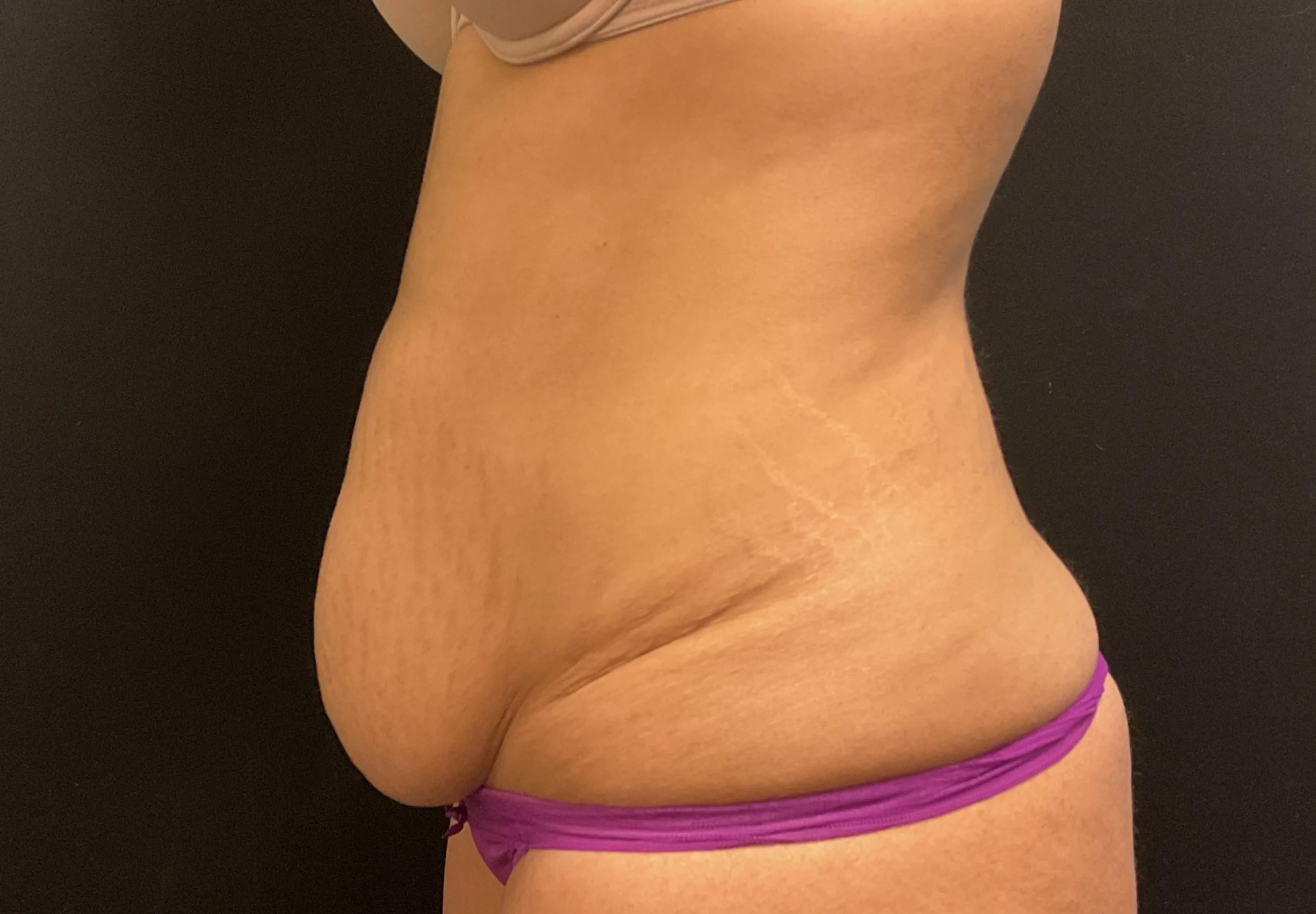 Tummy Tuck Patient Photo - Case Case 23 - before view-1