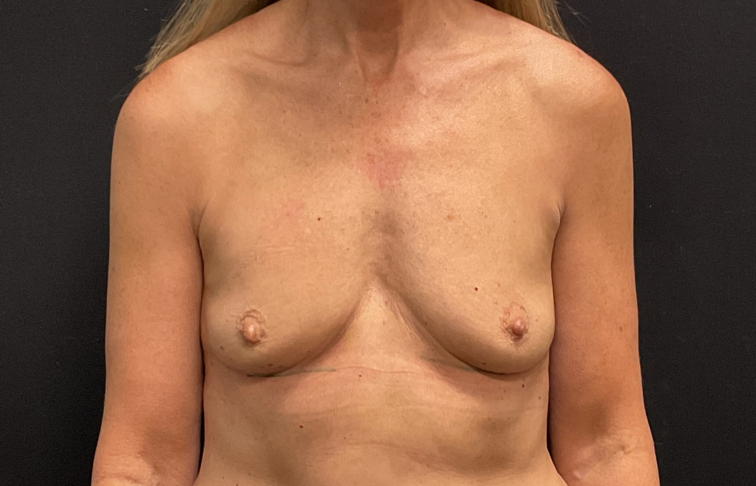 Breast Augmentation Patient Photo - Case Case 64 - before view-