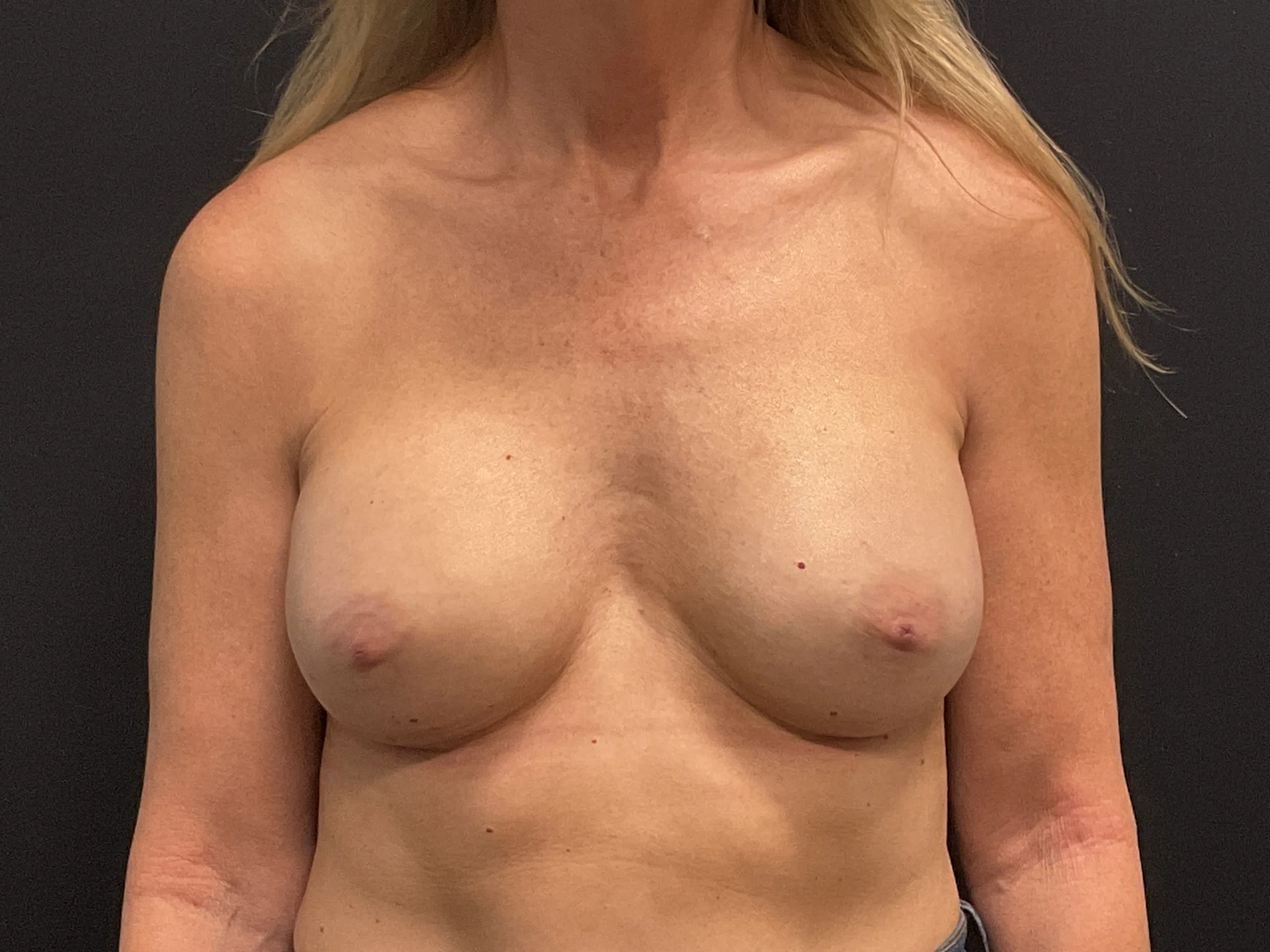 Breast Augmentation Patient Photo - Case Case 64 - after view-0