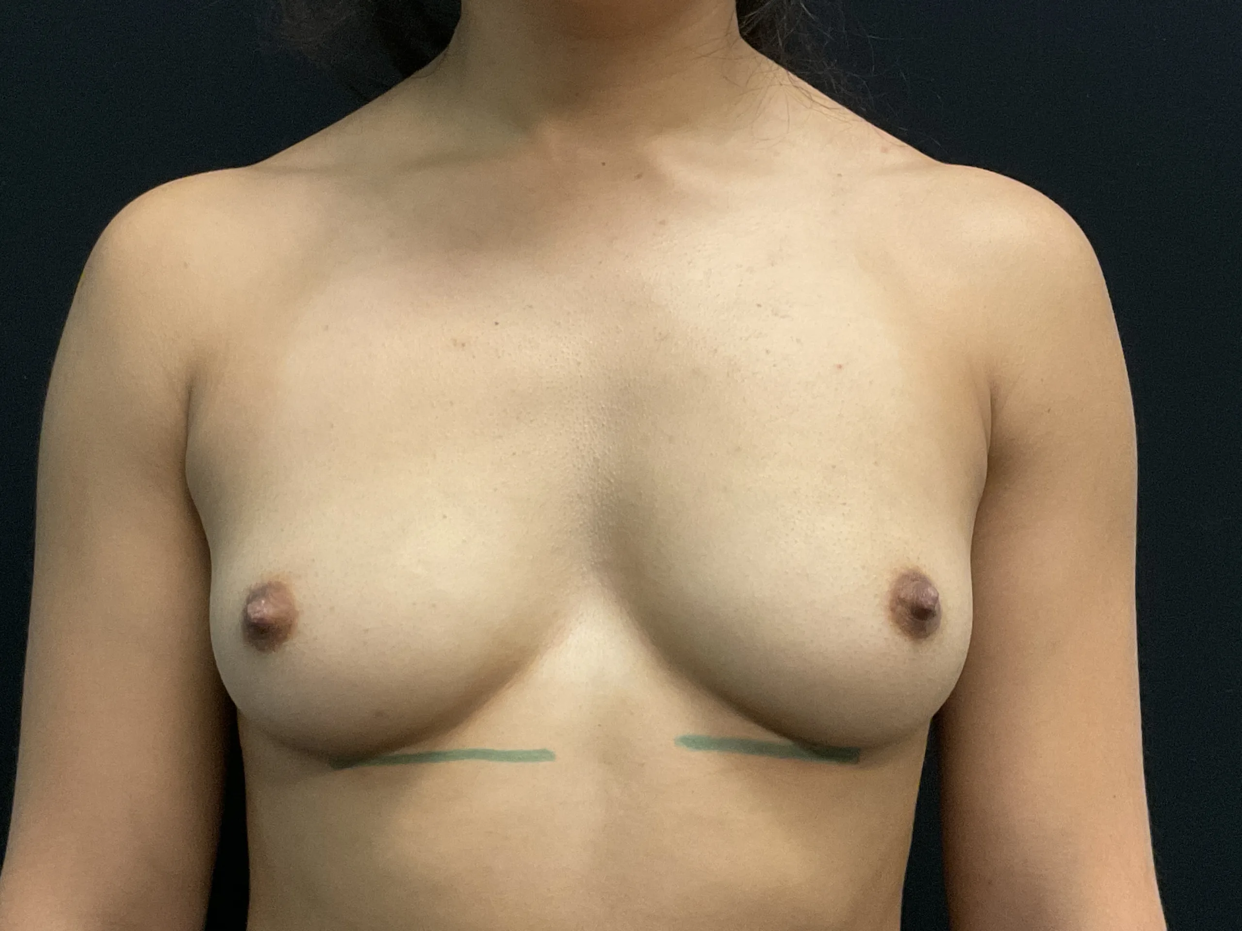 Breast Augmentation Patient Photo - Case Case 66 - before view-