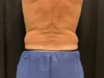 Coolsculpting - Case Case 20 - Before