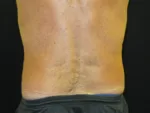 Coolsculpting - Case Case 21 - After