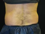 Coolsculpting - Case Case 21 - Before
